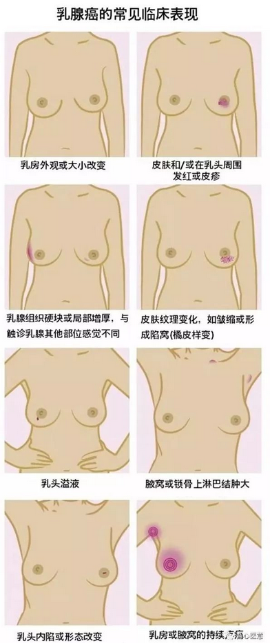 乳腺癌發(fā)生轉(zhuǎn)移了，手術(shù)還有意義嗎？